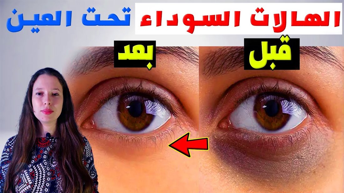 كيفية التخلص من الهالات السوداء تحت العين في وقت قصير