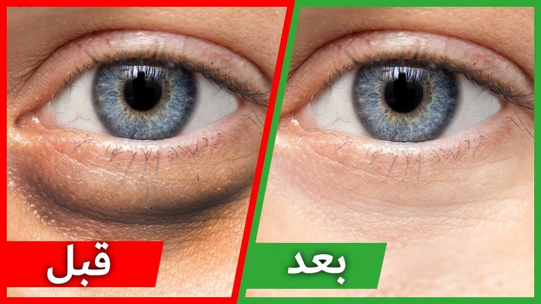 كيفية التخلص من الهالات السوداء تحت العين في وقت قصير