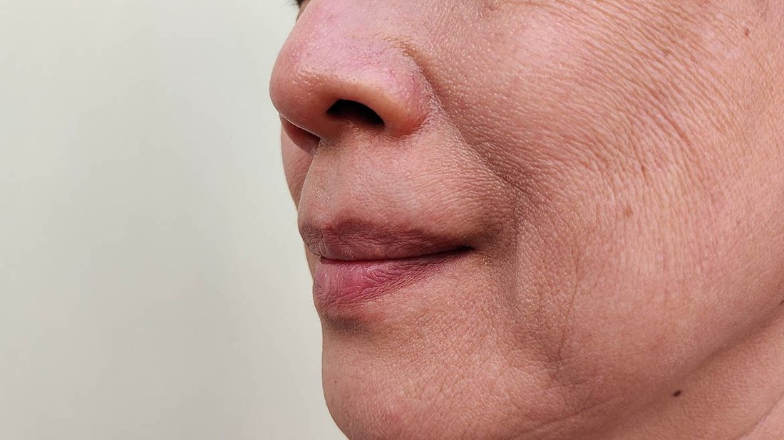 How to Prevent Wrinkles and Fine Lines Without Expensive Cosmetic Surgery