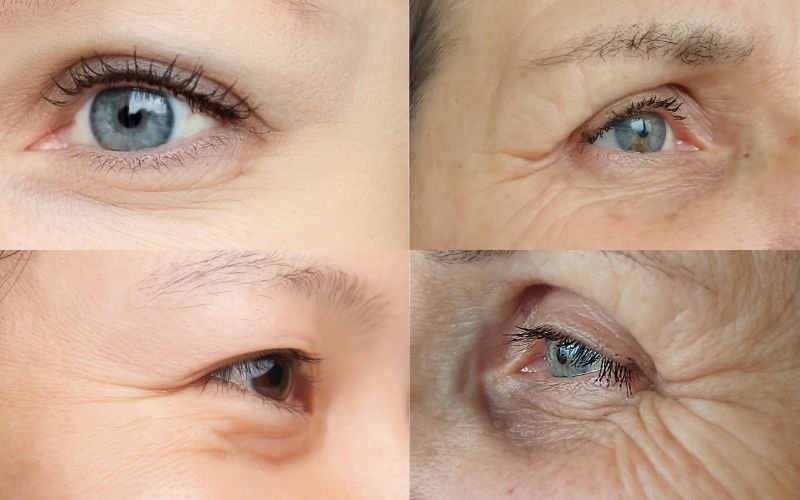 How to Prevent Wrinkles and Fine Lines Without Expensive Cosmetic Surgery