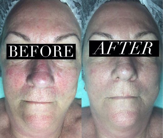 The Truth About Red Light Therapy and Its Effect on Aging