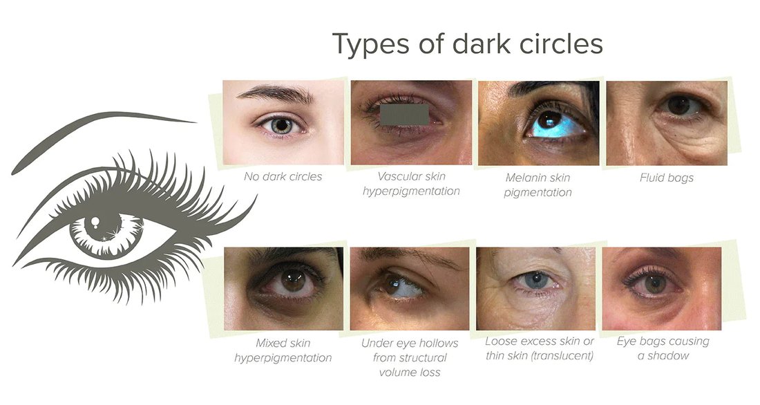 The Root Causes of Dark Under Eye Circles and Permanent Home Remedies