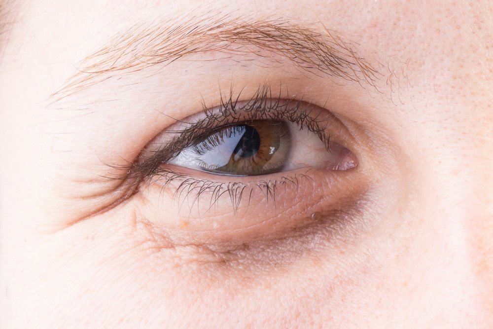 The Root Causes of Dark Under Eye Circles and Permanent Home Remedies