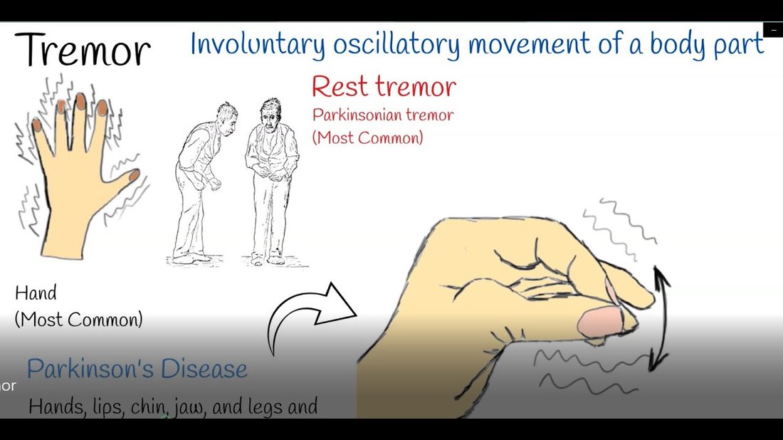 Causes of Hand Tremors in Young Adults and When to See a Specialist